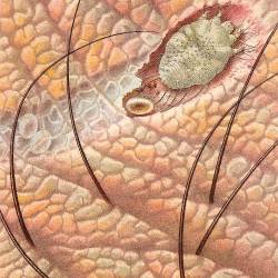 Garje so nenevarna in enostavno ozdravljiva nalezljiva bolezen, ki jo povzroča parazit (pršica) (WIKIMEDIA)