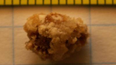 Ledvični kamen je usedlina mineralov in soli, ki nastane v ledvicah zaradi koncentriranega urina, pomanjkanja tekočine ali prehrane