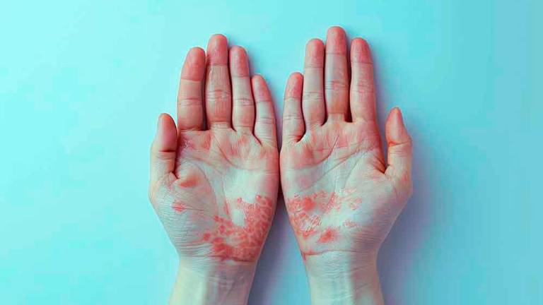 V FJK sedem okuženih z virusom opičjih koz