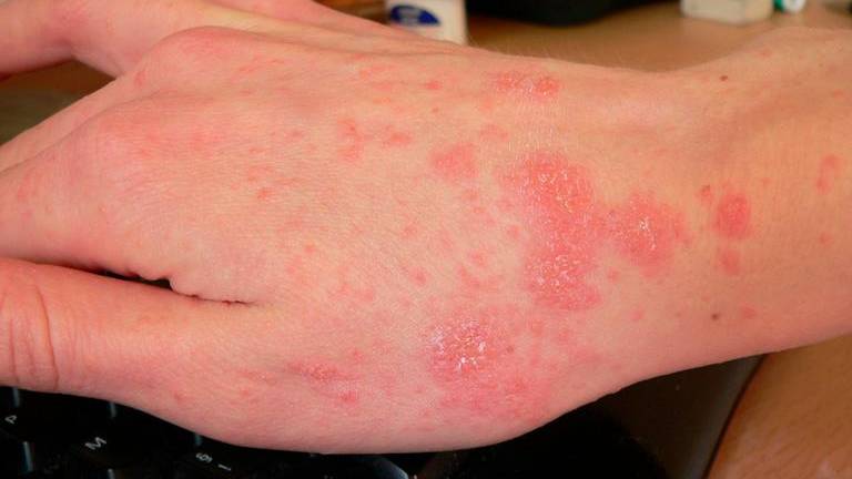 Na NIJZ letos prejeli 92 prijav garij