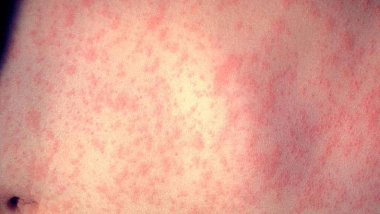 Epidemija o&scaron;pic v Srbiji terjala 13 življenj