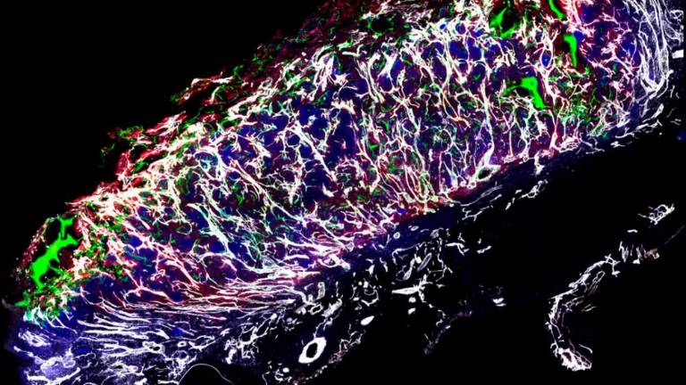 Z maščobnimi celicami do boljše oskre težavnih kroničnih ran